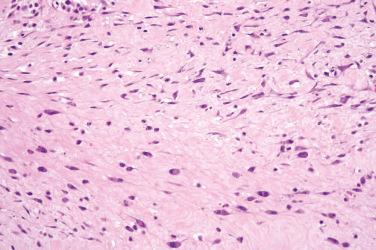 Fig. 3, Ischemic fasciitis.