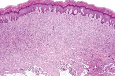 Fig. 1, Dermatomyofibroma.