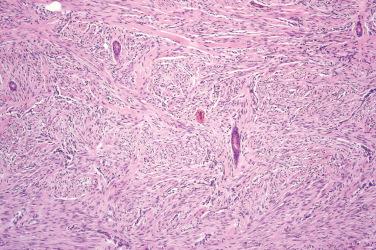 Fig. 3, Dermatomyofibroma.