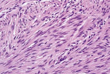 Fig. 4, Dermatomyofibroma.