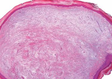 Fig. 1, Superficial acral fibromyxoma.