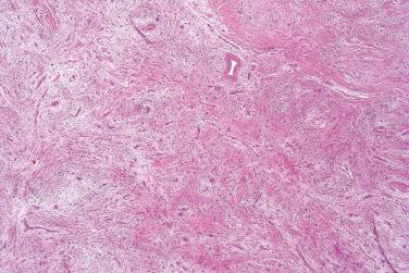 Fig. 2, Superficial acral fibromyxoma.