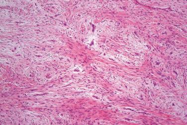 Fig. 3, Superficial acral fibromyxoma.