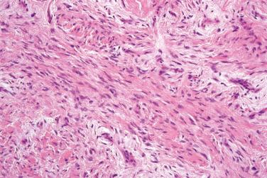 Fig. 4, Superficial acral fibromyxoma.