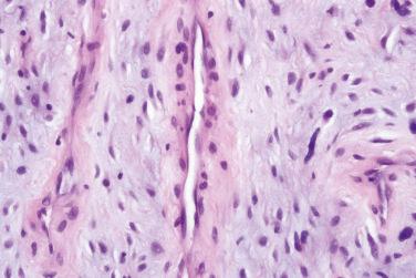 Fig. 5, Superficial acral fibromyxoma.