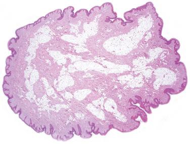 Fig. 1, Fibroepithelial polyp.