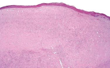 Fig. 1, Sclerotic fibroma.