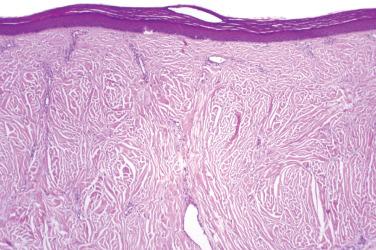 Fig. 1, Proteus syndrome.