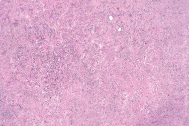 Fig. 2, Sclerotic fibroma.