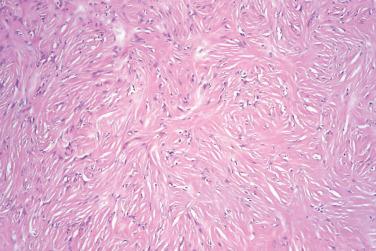 Fig. 3, Sclerotic fibroma.