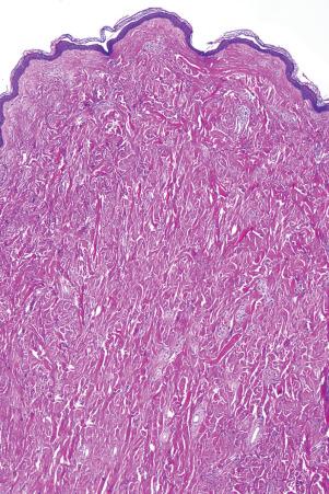 Fig. 1, Pleomorphic fibroma.