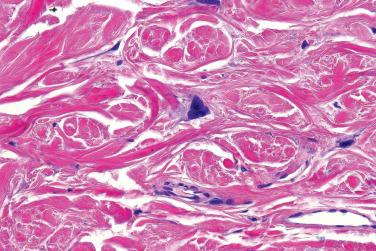 Fig. 2, Pleomorphic fibroma.