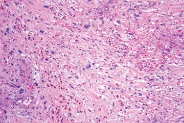 Fig. 6, Pleomorphic fibroma.