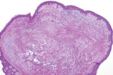 Fig. 8, Pleomorphic fibroma.