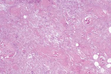 Fig. 1, Nuchal fibroma.