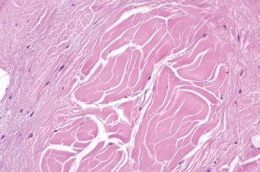 Fig. 3, Nuchal fibroma.