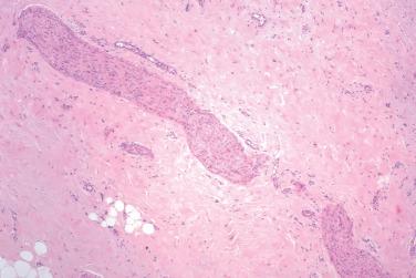 Fig. 4, Nuchal fibroma.