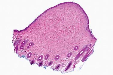 Fig. 1, Gardner fibroma.