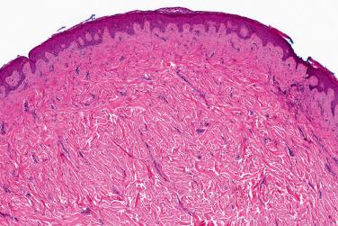 Fig. 2, Gardner fibroma.