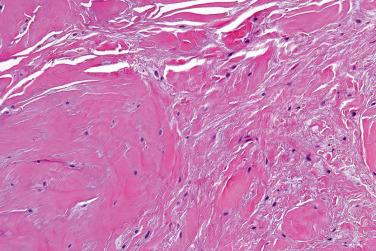 Fig. 2, Nuchal fibrocartilaginous pseudotumor.