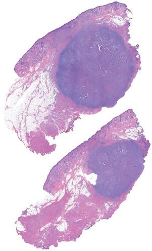 Fig. 1, Nodular fasciitis.