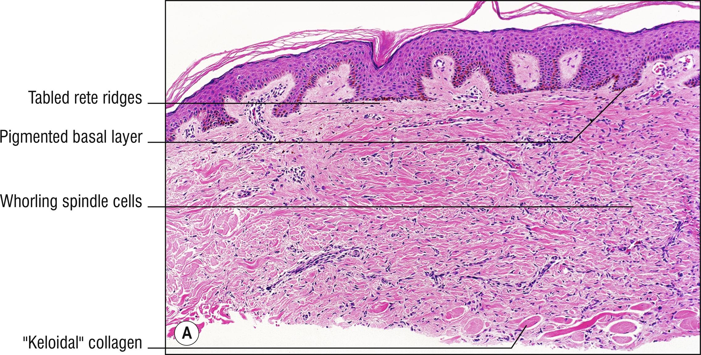 Fig. 27.1, A Dermatofibroma (low mag.).