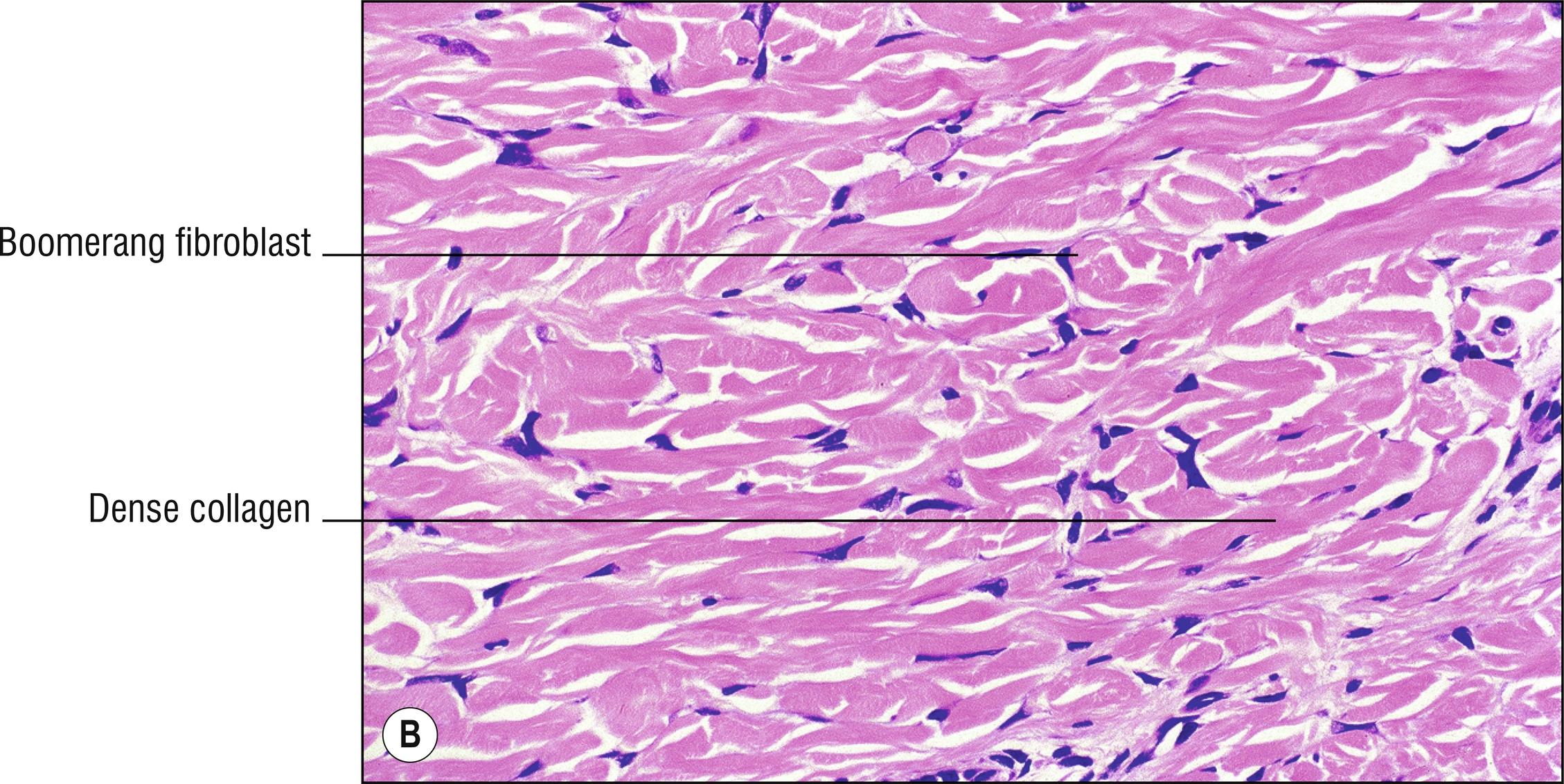 Fig. 27.1, B Dermatofibroma (high mag.).