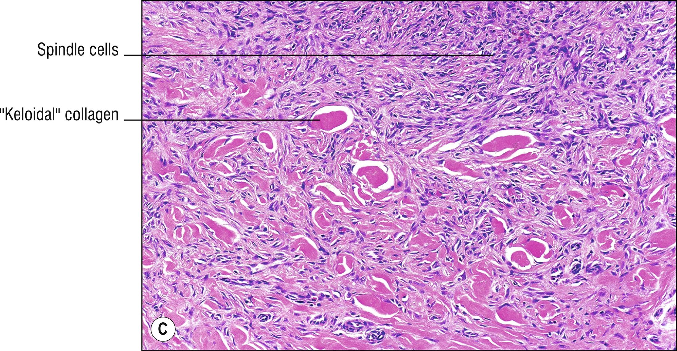 Fig. 27.1, C Dermatofibroma (high mag.).