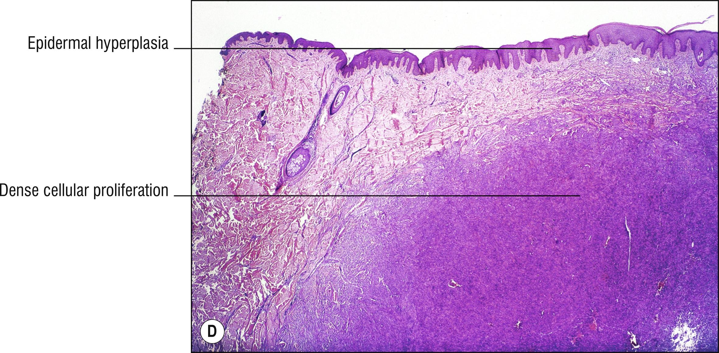 Fig. 27.1, D Dermatofibroma (cellular type).