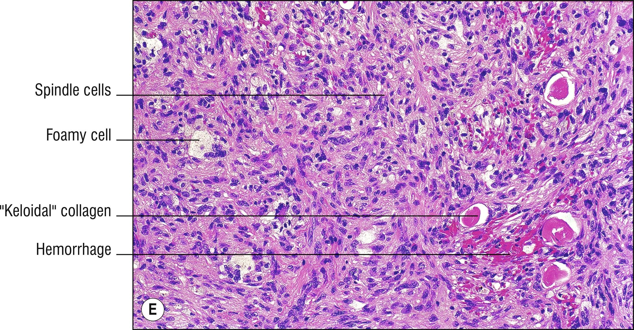 Fig. 27.1, E Xanthomatous dermatofibroma.