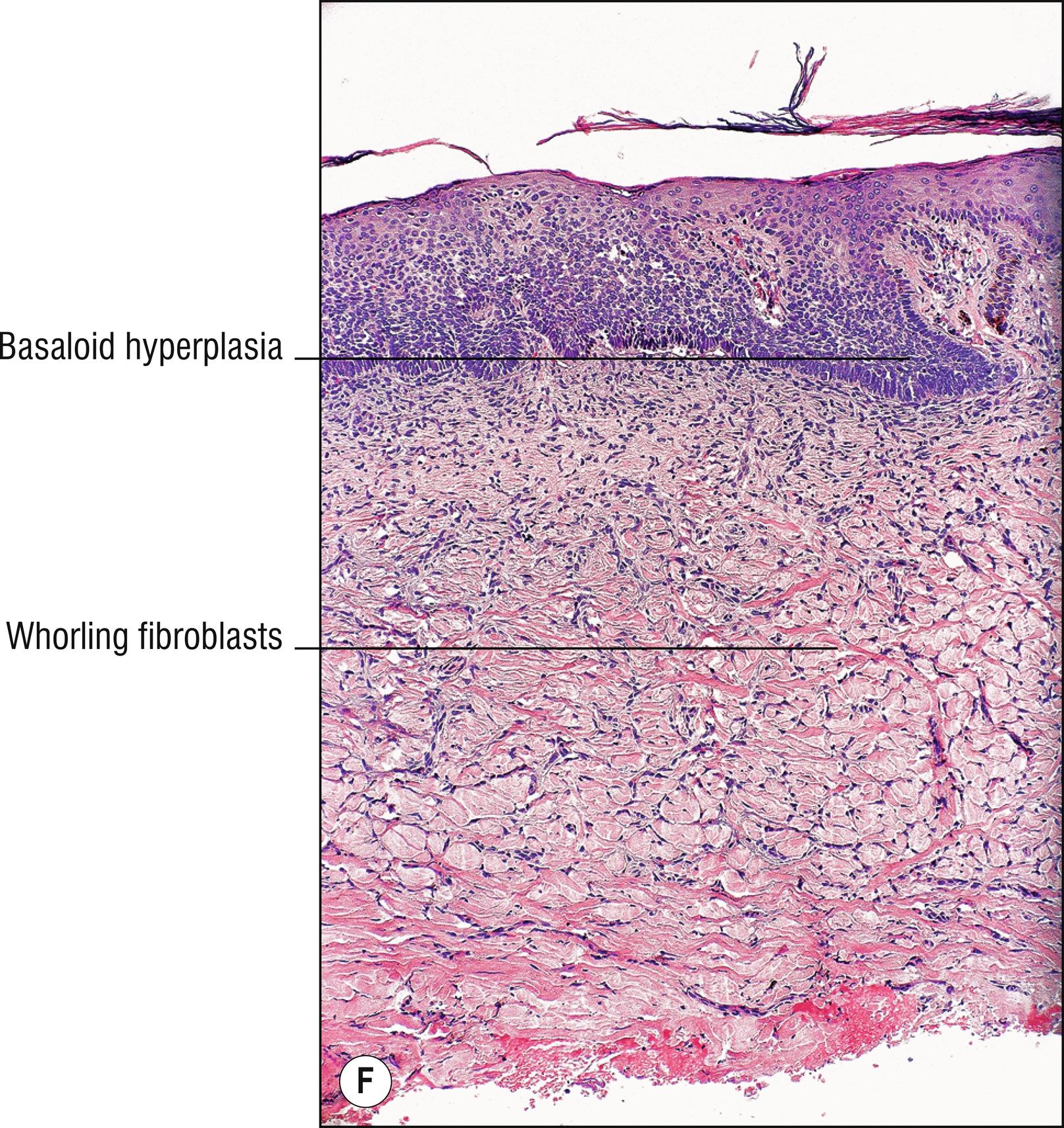 Fig. 27.1, F Dermatofibroma with basaloid hyperplasia.