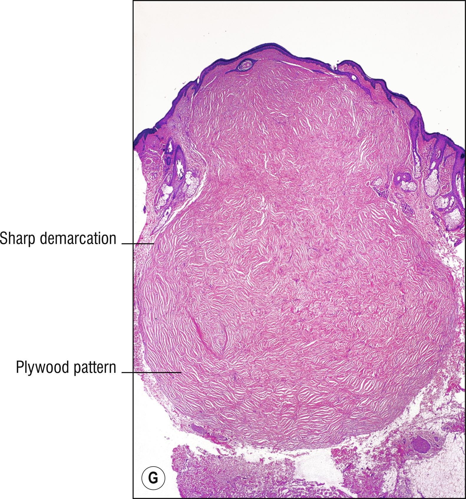 Fig. 27.1, G Sclerotic fibroma (low mag.).