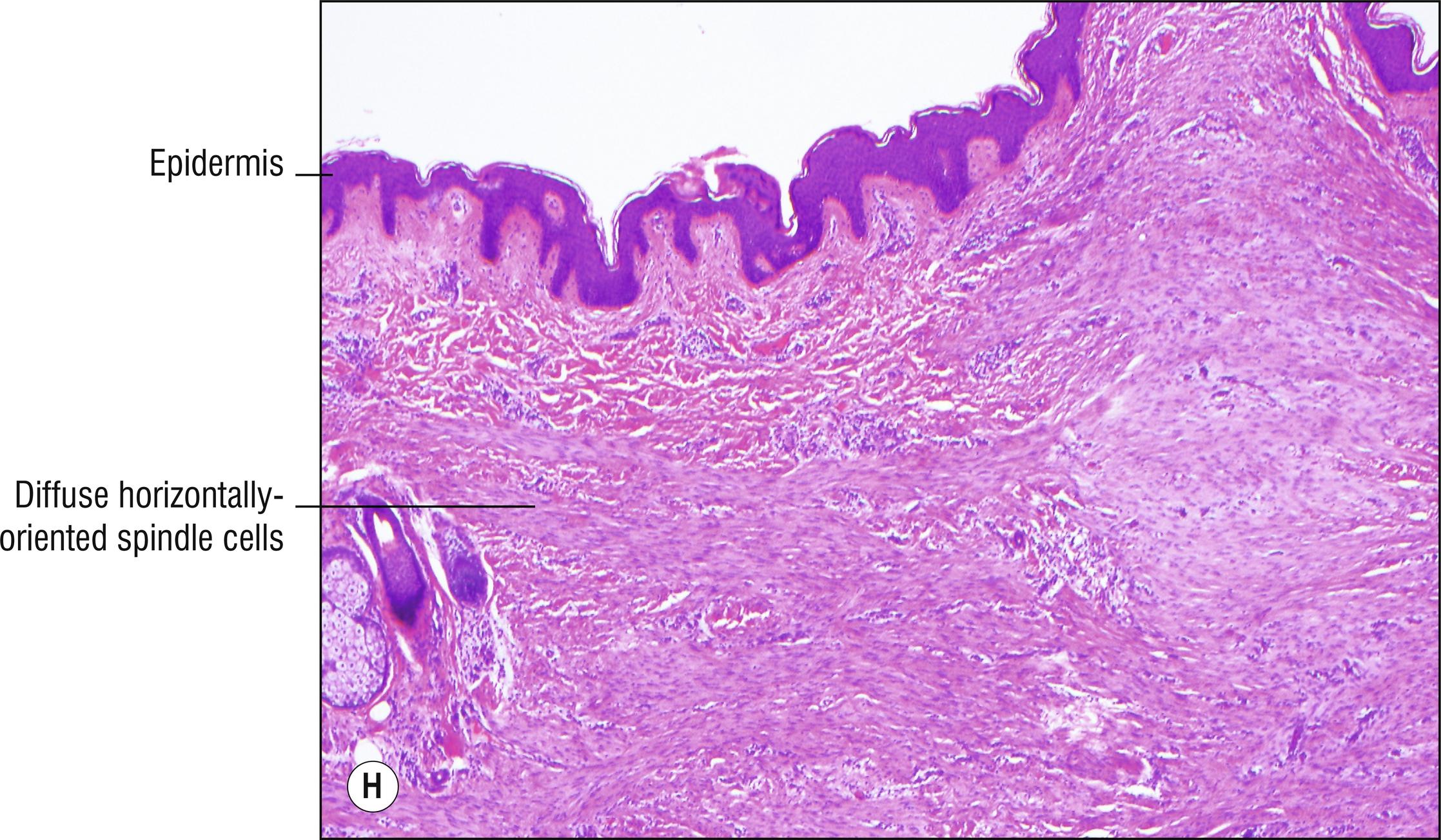 Fig. 27.1, H Dermatomyofibroma.