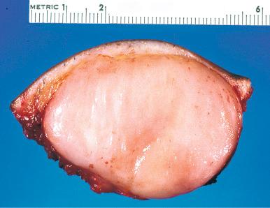 Fig. 11.1, Typical dermatofibrosarcoma protuberans (DFSP) involving dermis and subcutis in a nodular fashion.
