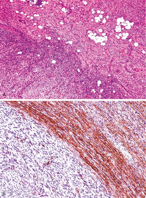 Fig. 11.12, A, DFSP showing transition to fibrosarcoma ( lower left corner ). B, CD34 immunostain in dermatofibrosarcoma ( upper right ) with fibrosarcomatous areas. Note marked diminution of CD34 immunostain in fibrosarcomatous portion of tumor ( lower left ).