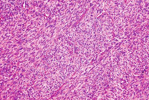 Fig. 11.13, Fibrosarcomatous areas within DFSP.