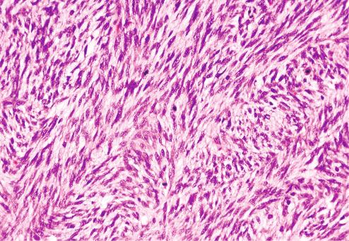 Fig. 11.14, Fibrosarcomatous areas showing increased cellularity and mitotic activity.