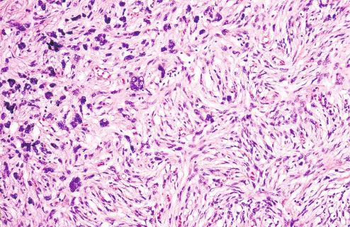 Fig. 11.15, DFSP with transformation to undifferentiated pleomorphic sarcoma.