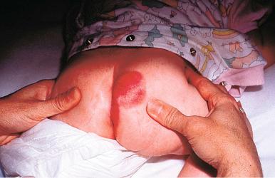 Fig. 11.3, DFSP from buttock of young child. It has the red color that some of these lesions exhibit.