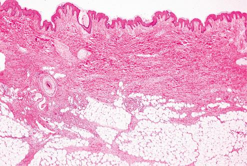 Fig. 11.5, Plaque form of DFSP illustrating expansion of interface between dermis and subcutis and extension into subcutaneous fat.