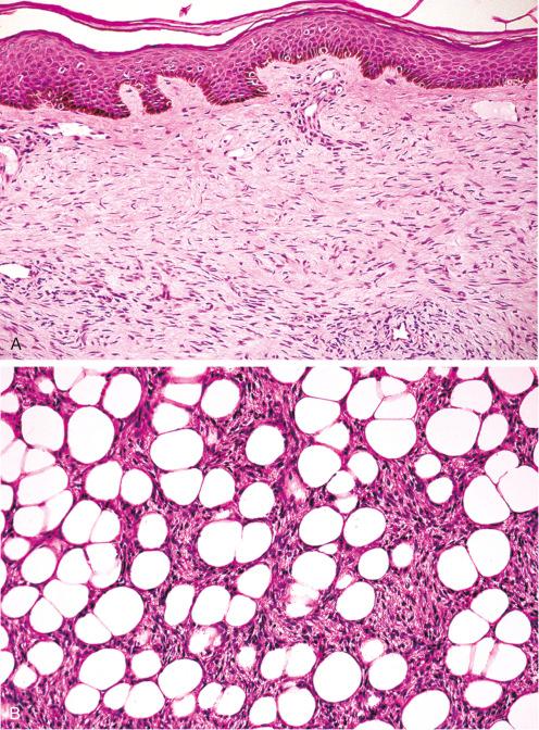 Fig. 11.6, Superficial ( A ) and deep ( B ) extensions of DFSP. Spread of the tumor between preexisting collagen of the dermis may simulate the appearance of a cutaneous fibrous histiocytoma ( A ). At the deep margin the tumor intricately interdigitates with normal fat ( B ).