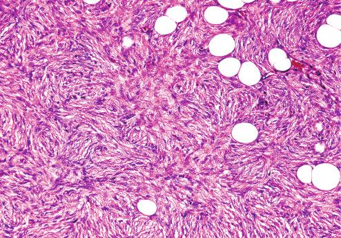 Fig. 11.8, Slender spindle cells arranged in distinct storiform pattern characterize most dermatofibrosarcomas.