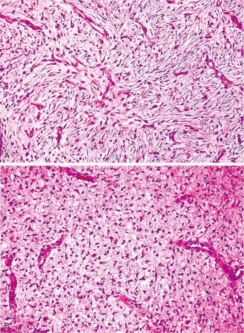 Fig. 11.10, A, Myxoid change in DFSP. B, When myxoid change is prominent, storiform pattern may be lacking altogether, and tumor may resemble a myxoid liposarcoma.