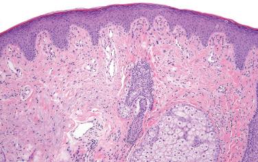 Fig. 1, Fibrous papule.