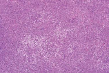 Fig. 4, Benign fibrous histiocytoma (dermatofibroma).