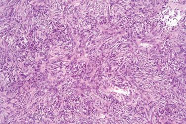 Fig. 5, Benign fibrous histiocytoma (dermatofibroma).