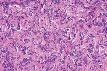 Fig. 6, Benign fibrous histiocytoma (dermatofibroma).