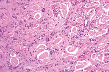 Fig. 9, Benign fibrous histiocytoma (dermatofibroma).