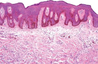 Fig. 11, Benign fibrous histiocytoma (dermatofibroma).