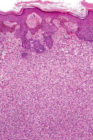 Fig. 12, Benign fibrous histiocytoma (dermatofibroma).